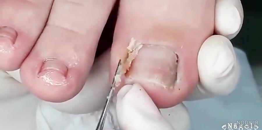 عسل و نمک برای عفونت ناخن عسل و نمک برای عفونت ناخن