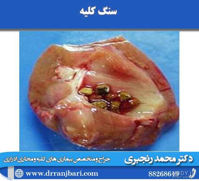 اندازه سنگ کلیه