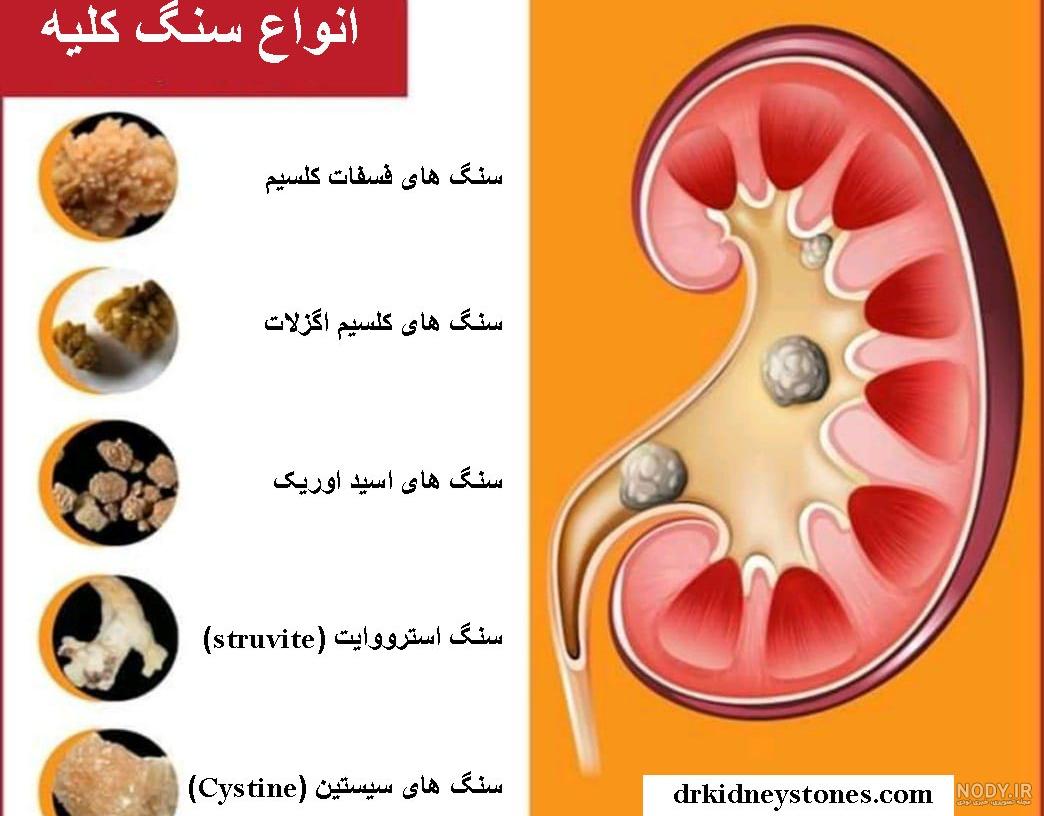 بهترین گزینه برای دفع سنگ کلیه