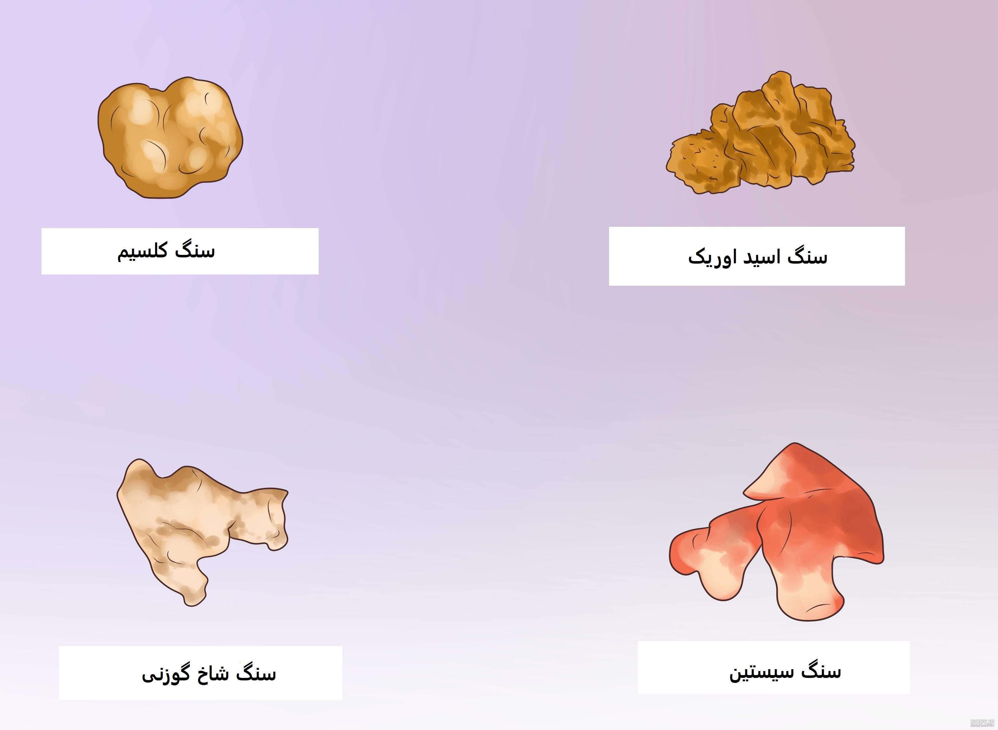 دفع سنگ کلیه 10 میلیمتری