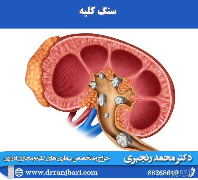 سنگ کلیه 3 میلیمتری نی نی سایت