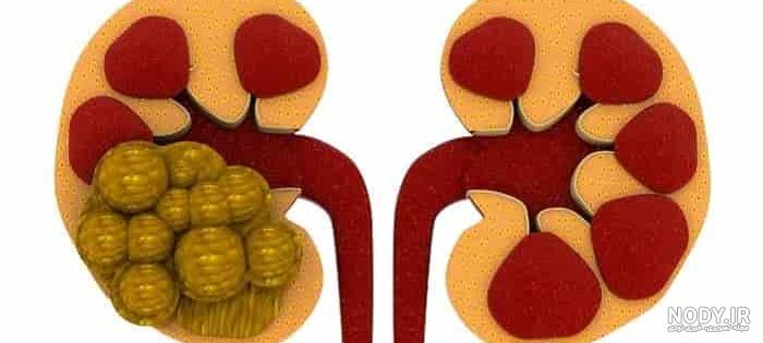 عرق خارخاسک و خارشتر برای سنگ کلیه