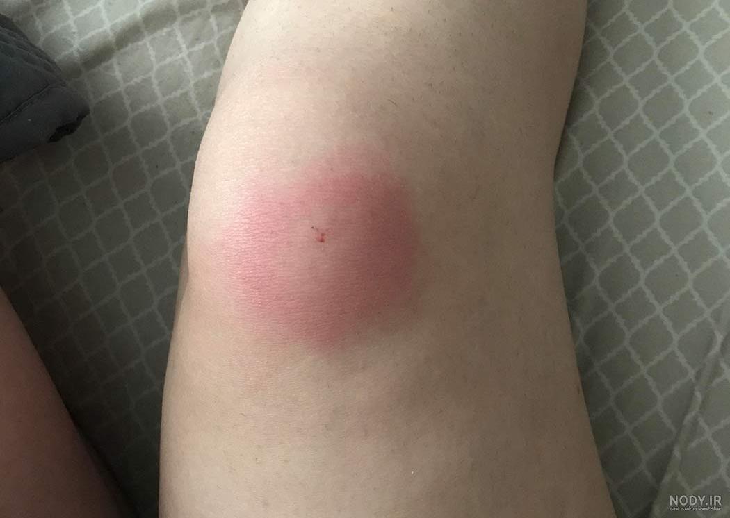 عکس نیش پشه خاکی