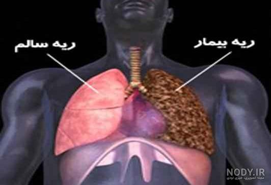 علت ورم ریه چیست
