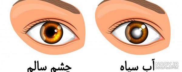 روش تشخیص گلوکوم روش تشخیص گلوکوم