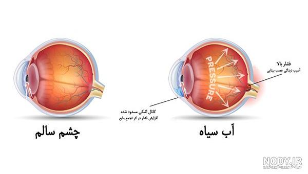 علت ایجاد گلوکوم علت ایجاد گلوکوم