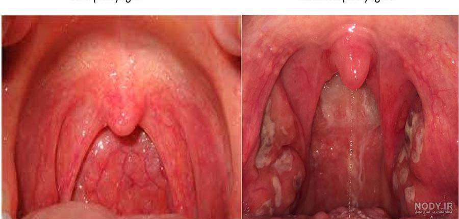 عکس داخل گلوی کرونایی عکس داخل گلوی کرونایی