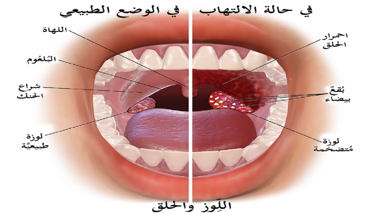 عکس عفونت گلوی کرونایی عکس عفونت گلوی کرونایی