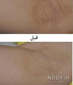 آیا لیزر زیر بغل باعث سرطان میشود آیا لیزر زیر بغل باعث سرطان میشود