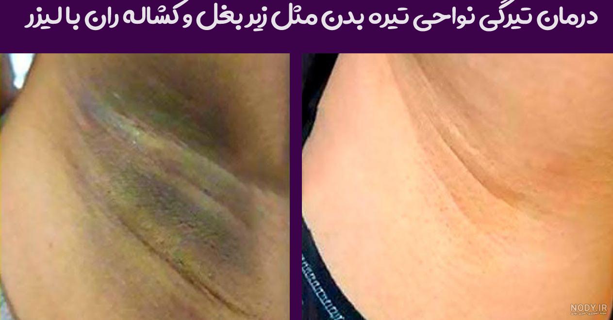 عوارض لیزر زیر بغل نی نی سایت عوارض لیزر زیر بغل نی نی سایت