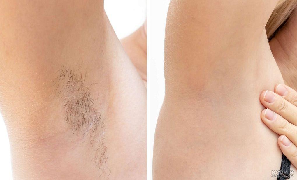 عکس زیر بغل لیزر شده عکس زیر بغل لیزر شده