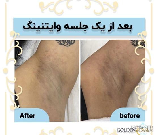 عکس قبل و بعد لیزر زیر بغل عکس قبل و بعد لیزر زیر بغل