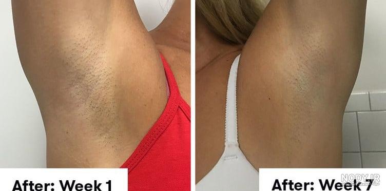 قبل از لیزر زیر بغل چه باید کرد قبل از لیزر زیر بغل چه باید کرد
