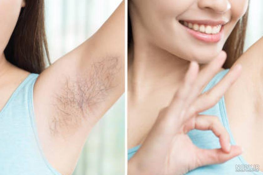 لک بعد از لیزر موهای زائد نی نی سایت لک بعد از لیزر موهای زائد نی نی سایت