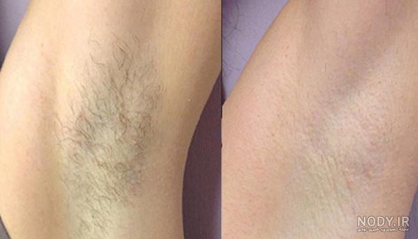 لیزر زیر بغل خطرناکه لیزر زیر بغل خطرناکه