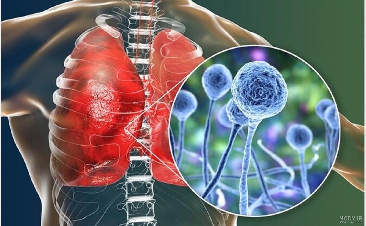 عکس کرونای قارچ سیاه