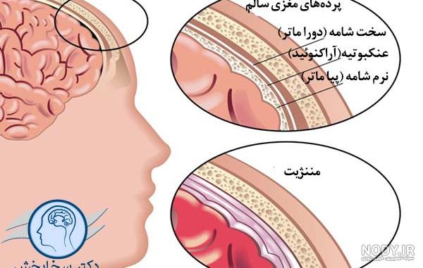 عکس های بیماری مننژیت عکس های بیماری مننژیت