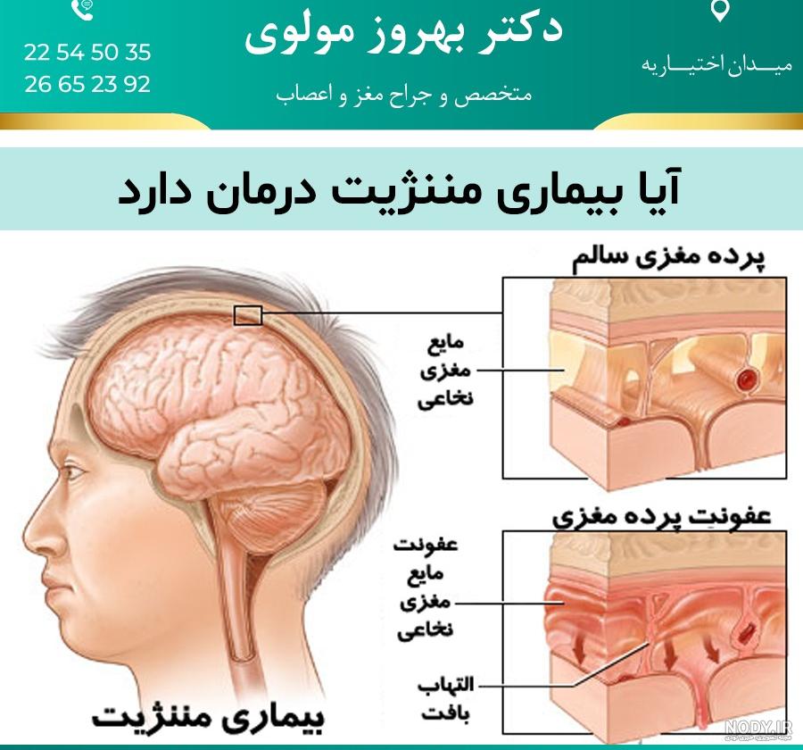 کودک عکس های بیماری مننژیت کودک عکس های بیماری مننژیت