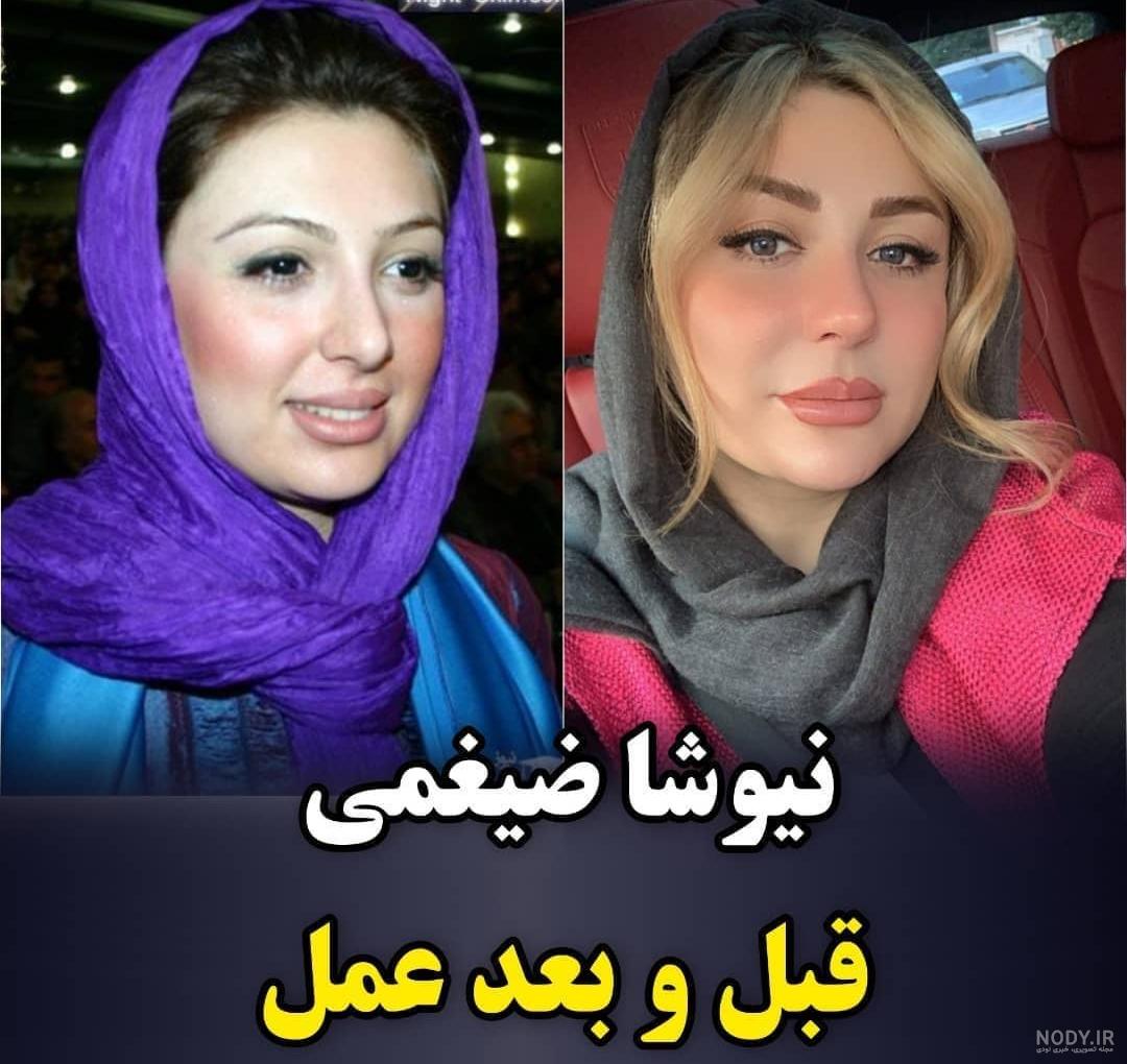 عکس نیوشا ضیغمی قبل عمل زیبایی عکس نیوشا ضیغمی قبل عمل زیبایی