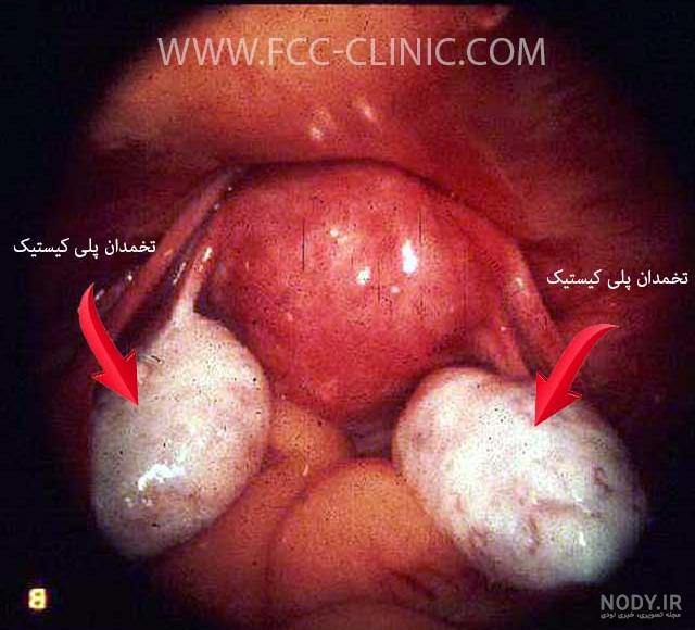 عکس واقعی تخمدان