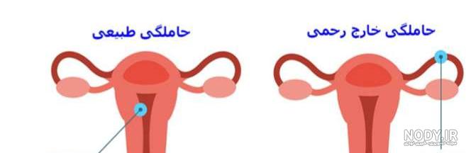 تصاویر بارداری خارج از رحم تصاویر بارداری خارج از رحم