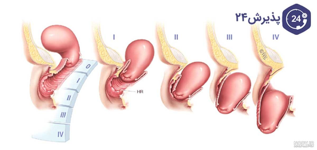 عکس جنین بارداری خارج از رحم عکس جنین بارداری خارج از رحم