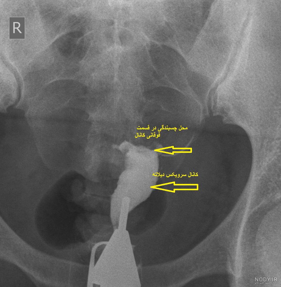 عکس سونوگرافی بارداری خارج از رحم عکس سونوگرافی بارداری خارج از رحم