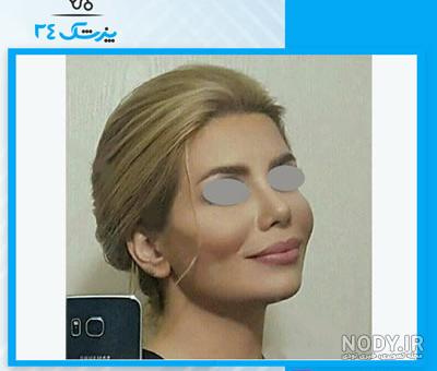 عکس نیوشا ضیغمی قبل از جراحی بینی