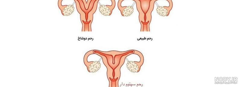 درمان گیاهی ضخیم شدن دیواره رحم