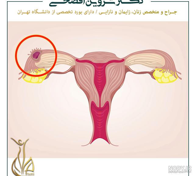كورتاژ تشخيصي عکس ضخیم شدن دیواره رحم