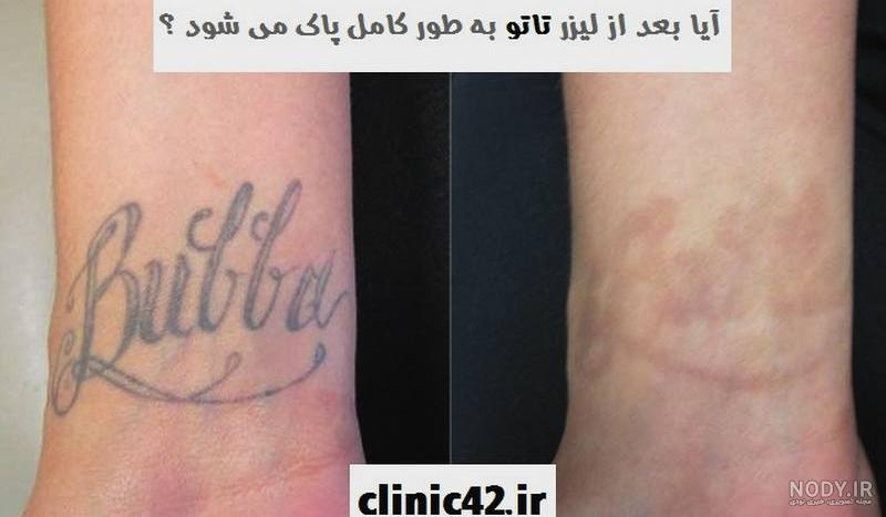 لیزر تاتو مشهد