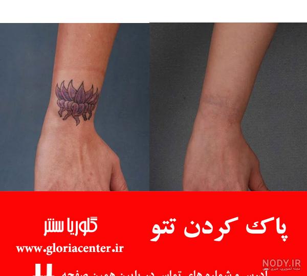 لیزر تاتوی ابرو