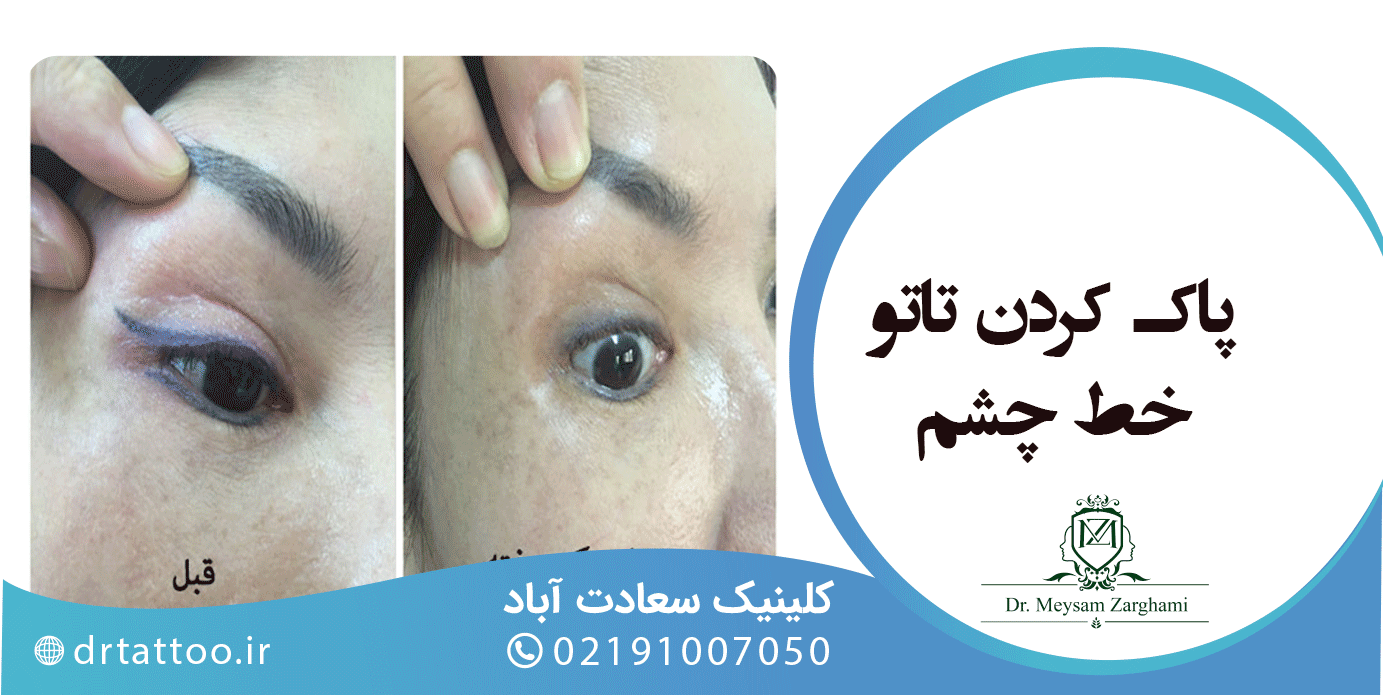 تاتو خط چشم بدون درد و خونریزی