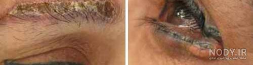 ضرر تاتو برای بدن