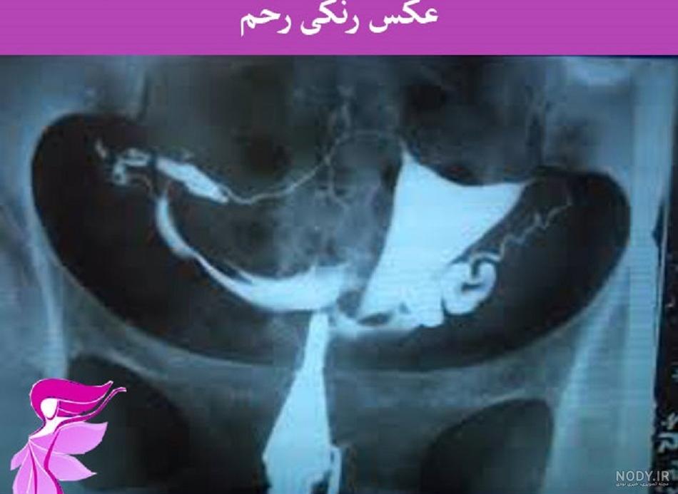 عکس رنگی رحم به انگلیسی عکس رنگی رحم به انگلیسی