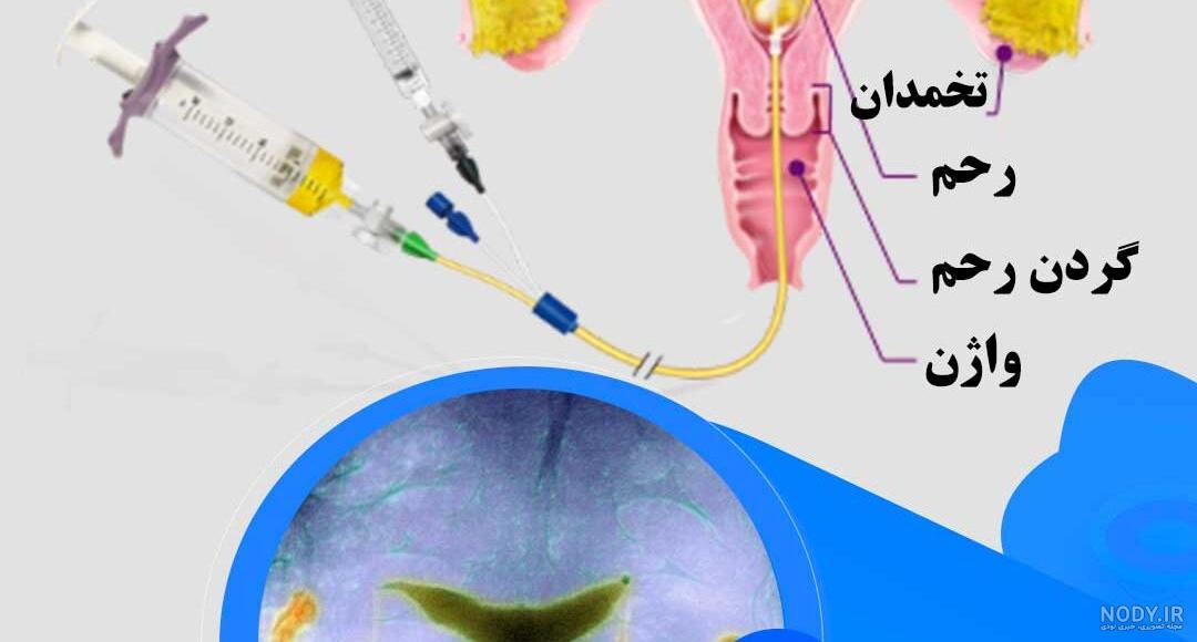 عکس رنگی رحم چیست عکس رنگی رحم چیست