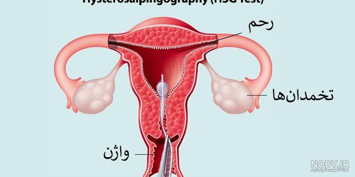 ناباروری ناباروری