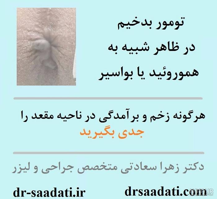 درمان بواسير