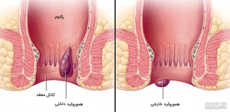 عکس بواسیر