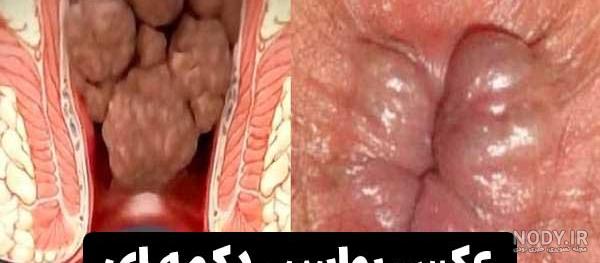 عکس بواسیر تازه