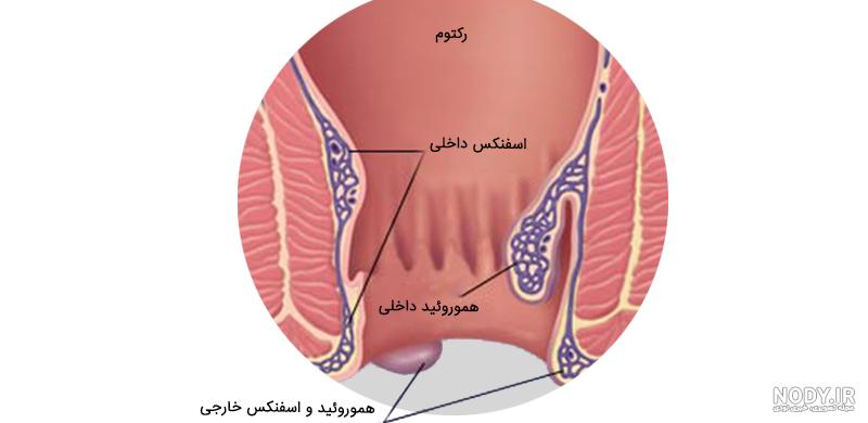 عکس بواسیر ترومبوزه