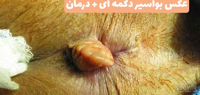 عکس بواسیر خارجی خفیف