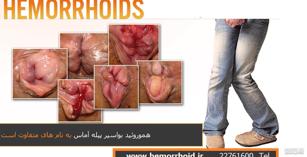 عکس بواسیر خفیف