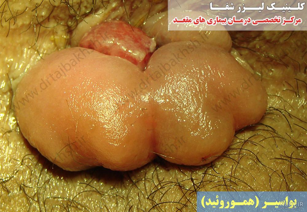 عکس بواسیر ساچمه ای