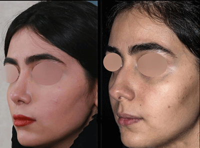 عکس عمل بینی دکتر شهریار یحیوی