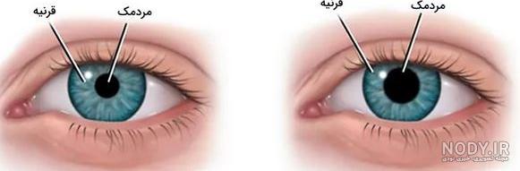 قرنیه قرنیه