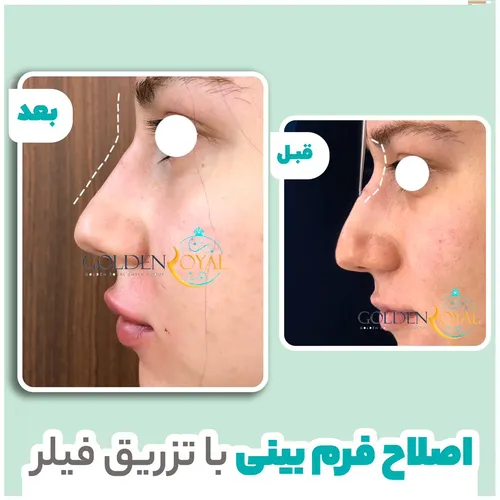 آنزیم بینی