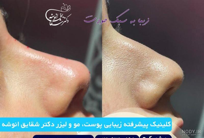 بوتاکس