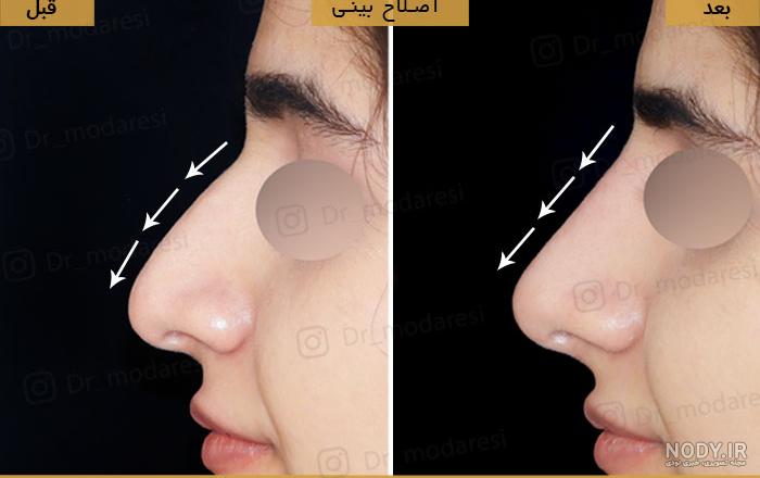 هزينه فيلر