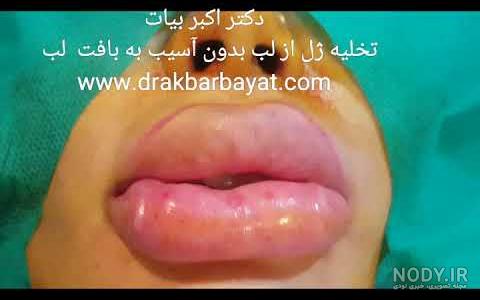 بوتاکس بوتاکس